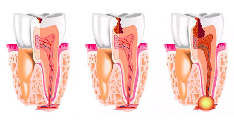 Причины, влекущие появление кисты зубов
