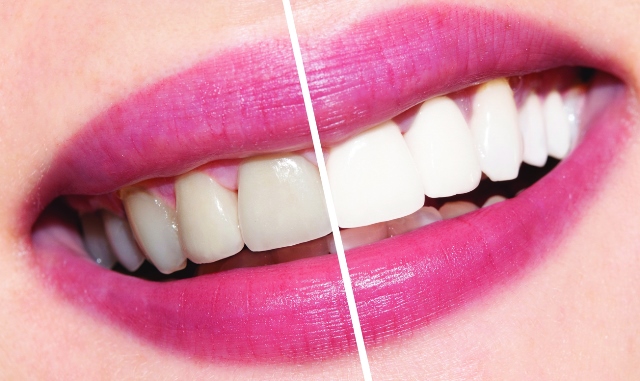 Как безопасно отбелить зубы, чтобы гарантировано добиться белоснежной улыбки